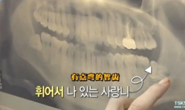 拔智齿视频全真实过程,拔智齿的真实手术过程